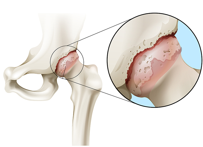 La coxarthrose