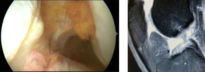 Ligament croisé antérieur