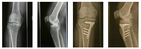 Chirurgie du genou - Prothèse